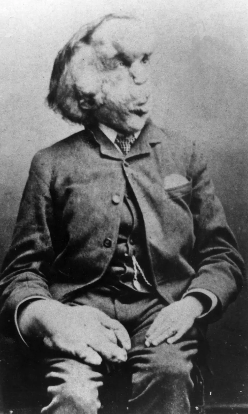 Joseph Merrick, carte de visite, about 1889