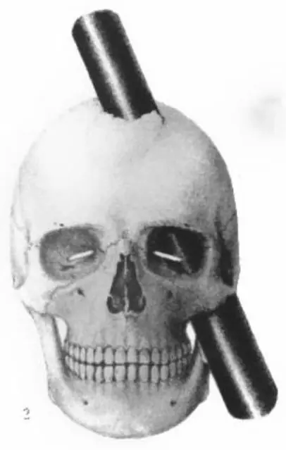 Henry J. Bigelow’s 1850 drawing of the iron’s path through the skull