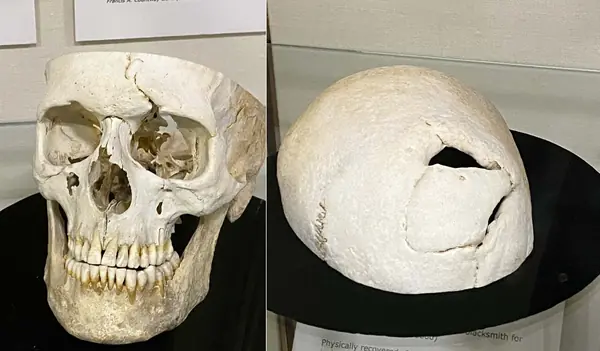 Gage’s skull at the Warren Anatomical Museum, Countway Library, 2023