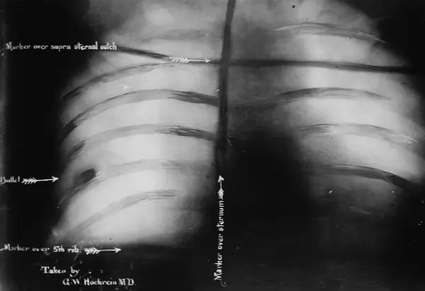 X-ray of Roosevelt’s chest showing the bullet, taken by G. W. Hochrein, M.D., 1912