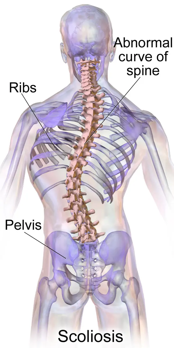 A medical illustration of scoliosis, Blausen Medical (not Bolt’s spine)